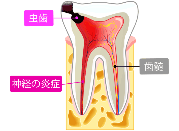 精密治療〜歯髄温存療法(VitalPulpTherapy)＆MTAセメント〜 | 千葉 
